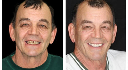 Full Denture Set Moldable Custom Fit Natural-Looking Teeth