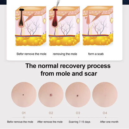 Skin Blemish Removal Pen Plasma Therapy & USB Rechargeable